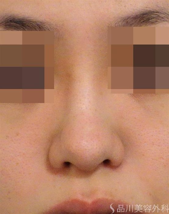 症例NO.42764のBEFORE写真