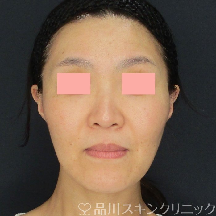 症例NO.72657のAFTER写真