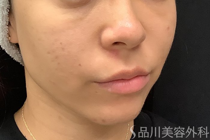 症例NO.67803のBEFORE写真