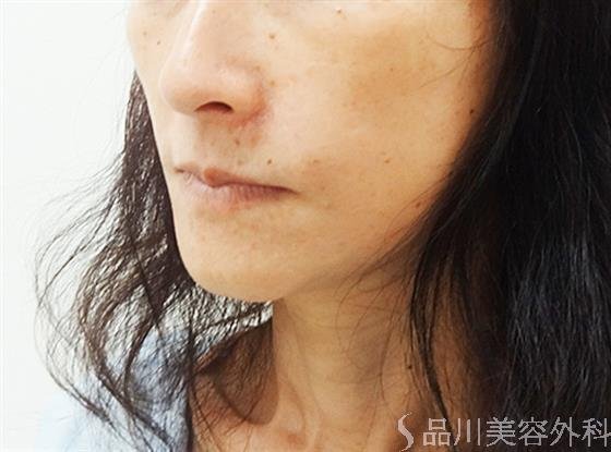 症例NO.30517のAFTER写真