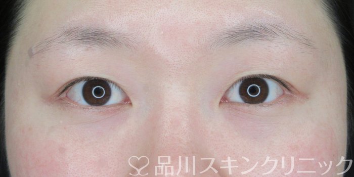 症例NO.70572のBEFORE写真