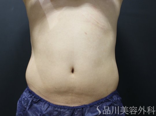 症例NO.74674のAFTER写真