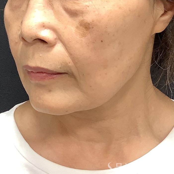 症例NO.75395のBEFORE写真