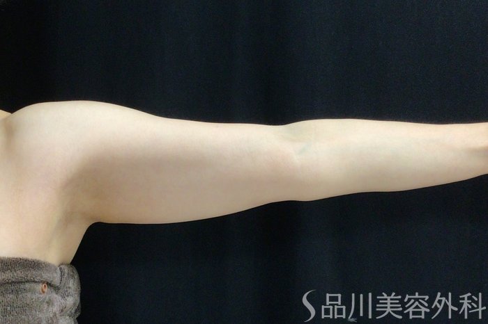 症例NO.69545のBEFORE写真