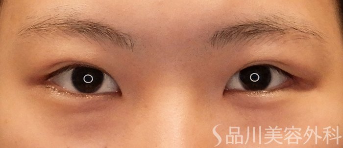 症例NO.71496のBEFORE写真