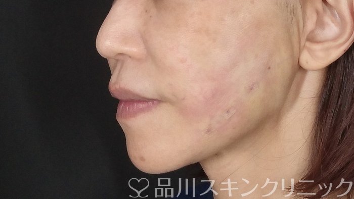 症例NO.72477のAFTER写真