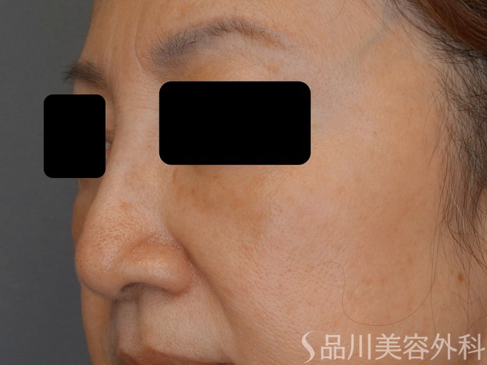症例NO.73964のAFTER写真