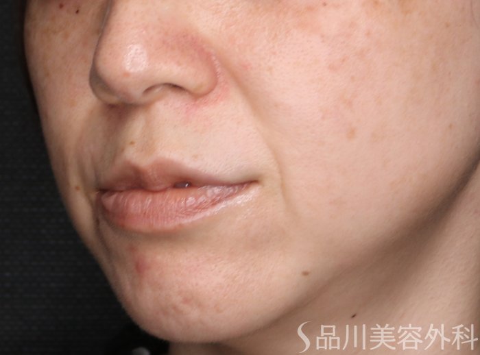 症例NO.75375のBEFORE写真