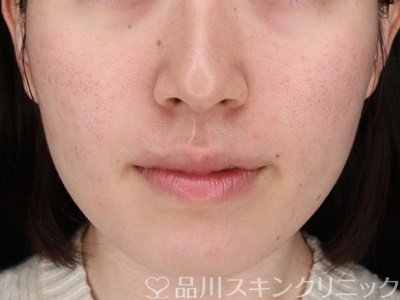 症例NO.71407のAFTER写真