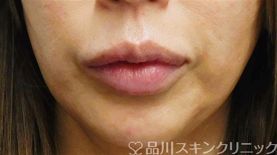 症例NO.60449のAFTER写真