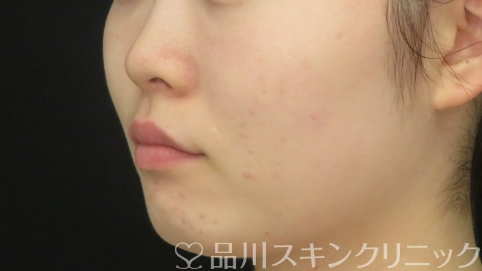 症例NO.72051のAFTER写真