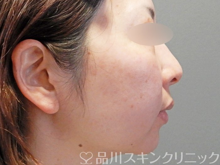 症例NO.69019のAFTER写真