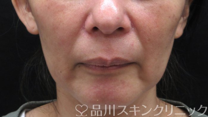 症例NO.69767のBEFORE写真