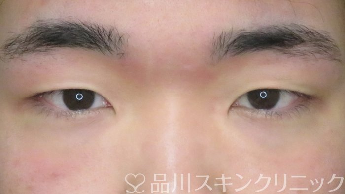 症例NO.69553のBEFORE写真