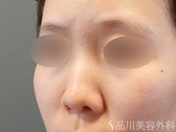 症例NO.65690のBEFORE写真