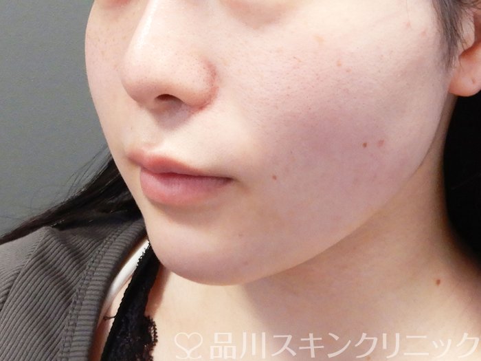 症例NO.72522のAFTER写真