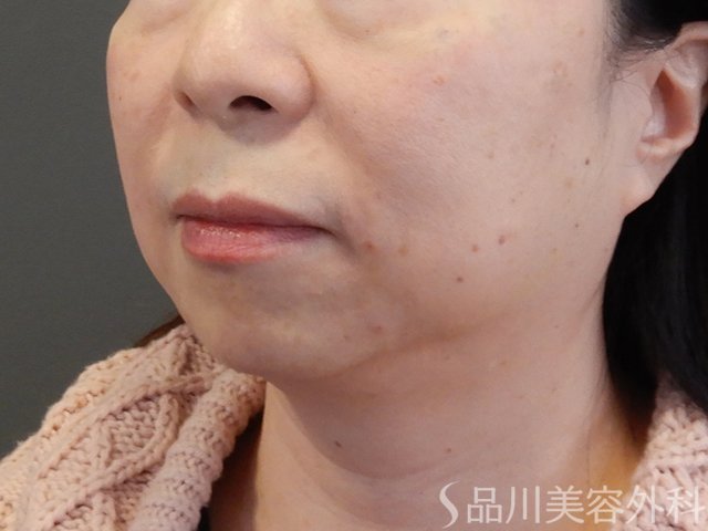 症例NO.69230のAFTER写真