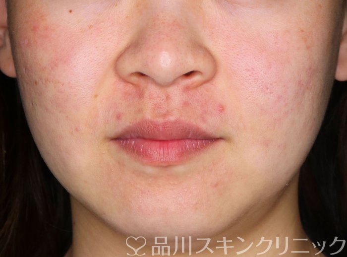 症例NO.64067のBEFORE写真