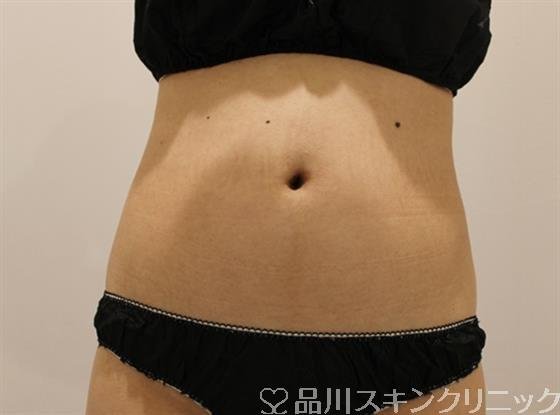症例NO.50456のBEFORE写真