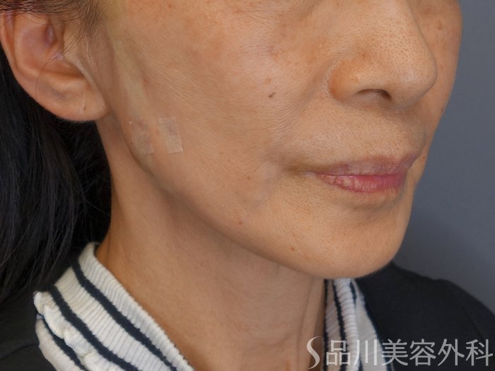 症例NO.72240のAFTER写真