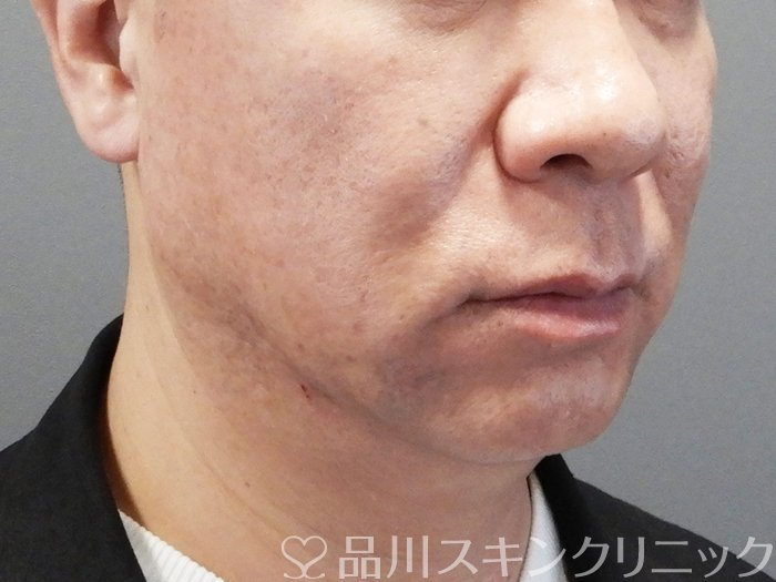 症例NO.73478のBEFORE写真