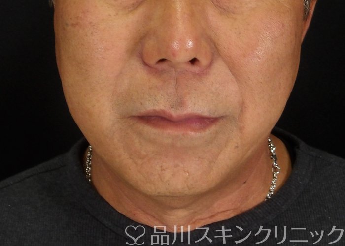 症例NO.70246のAFTER写真
