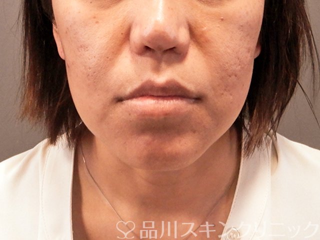 症例NO.70984のBEFORE写真