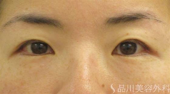 症例NO.47755のBEFORE写真