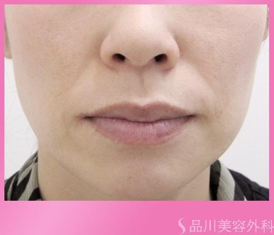 症例NO.1582のBEFORE写真