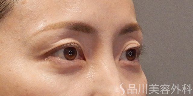 症例NO.74797のBEFORE写真