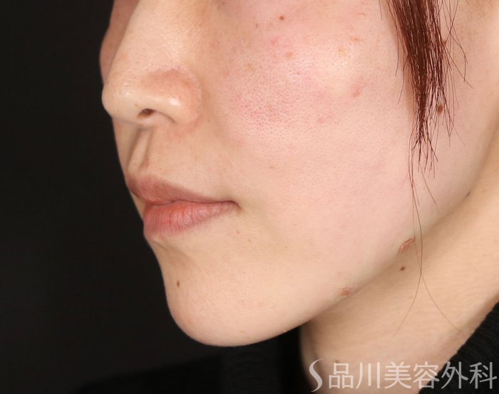 症例NO.73380のAFTER写真