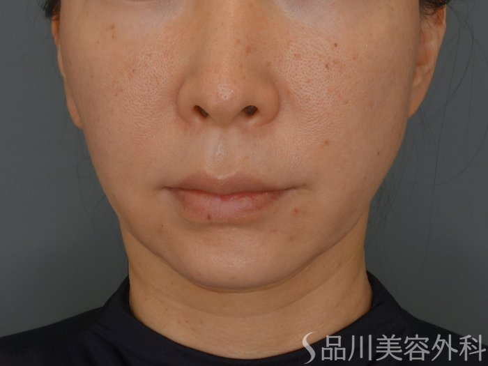 症例NO.74649のBEFORE写真