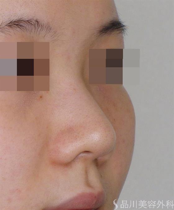症例NO.50988のBEFORE写真
