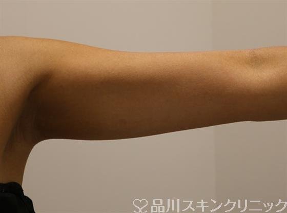 症例NO.42996のBEFORE写真