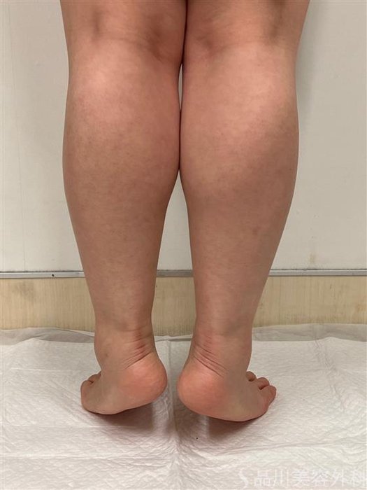 症例NO.55096のAFTER写真
