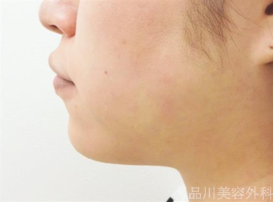 症例NO.33024のAFTER写真