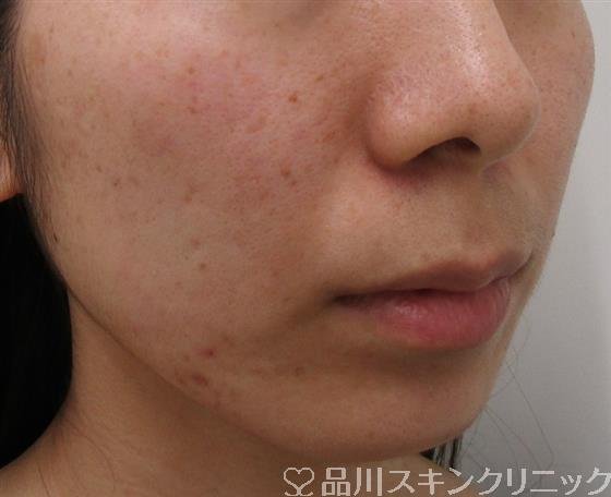症例NO.36919のBEFORE写真