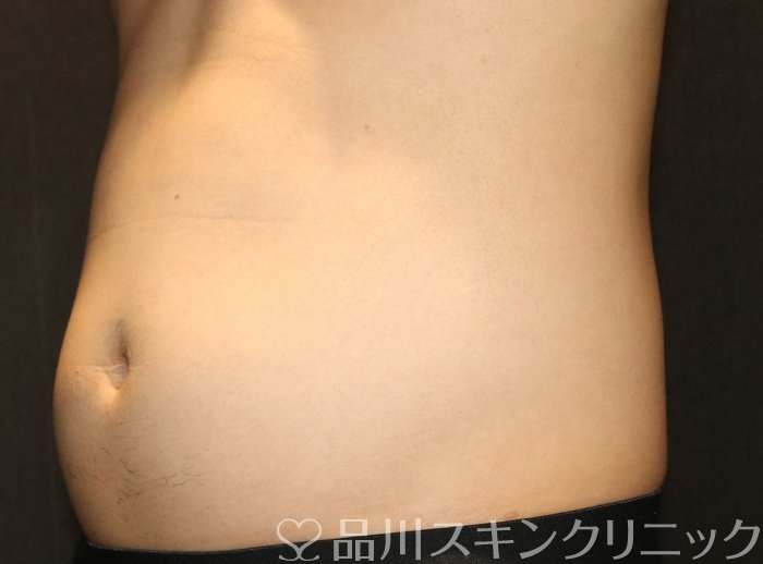 症例NO.74572のBEFORE写真