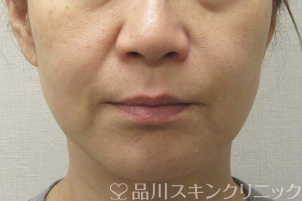 症例NO.74556のBEFORE写真