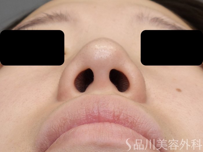 症例NO.70145のBEFORE写真