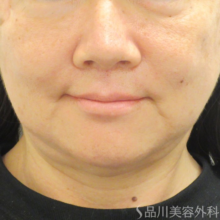 症例NO.74259のBEFORE写真