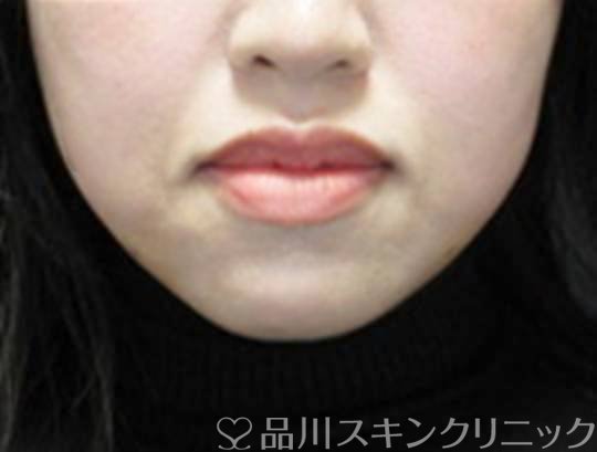 症例NO.72803のAFTER写真