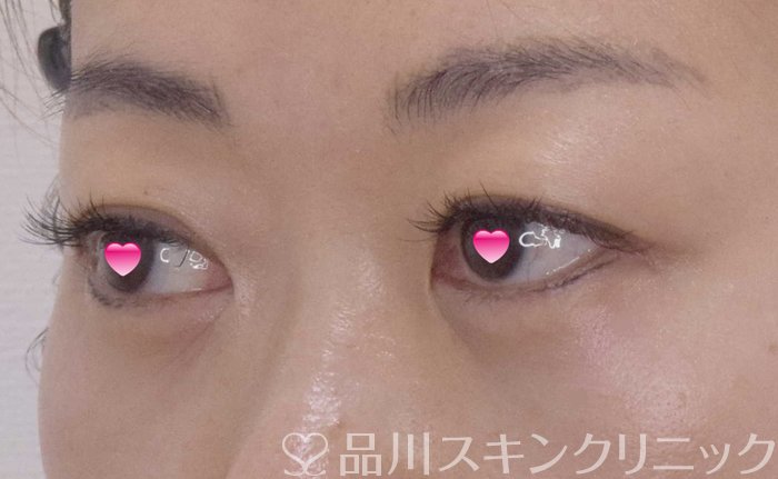 症例NO.65062のAFTER写真