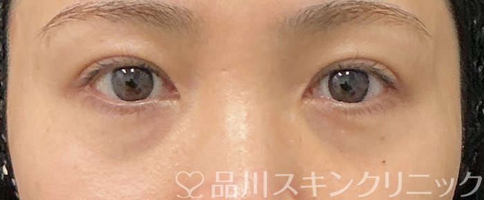 症例NO.75164のBEFORE写真