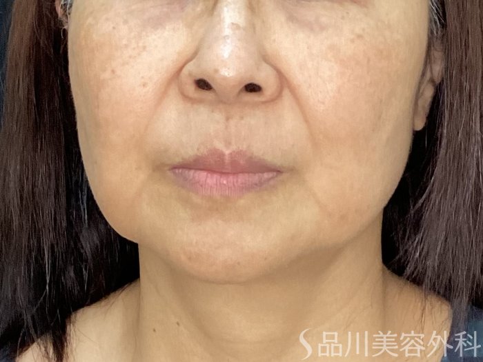 症例NO.71984のBEFORE写真