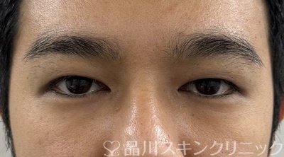 症例NO.69570のAFTER写真