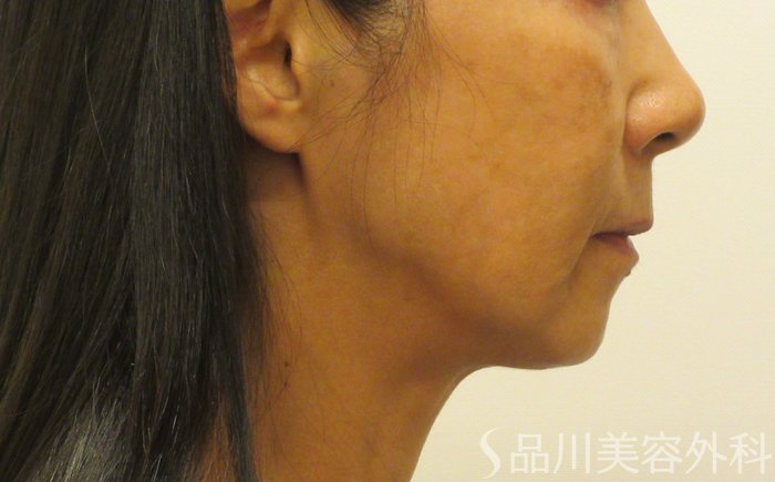 症例NO.71897のBEFORE写真