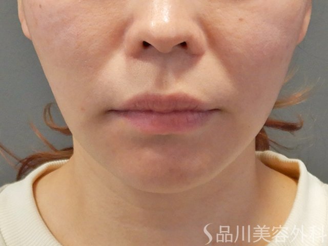 症例NO.73780のAFTER写真