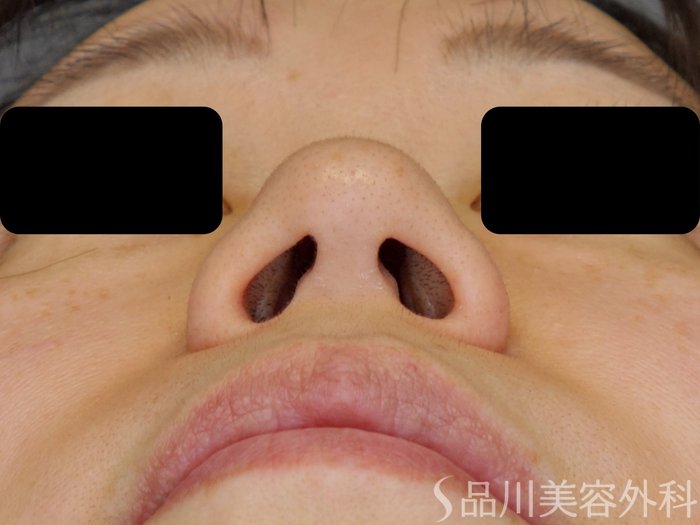 症例NO.72571のBEFORE写真