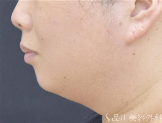 症例NO.57499のBEFORE写真